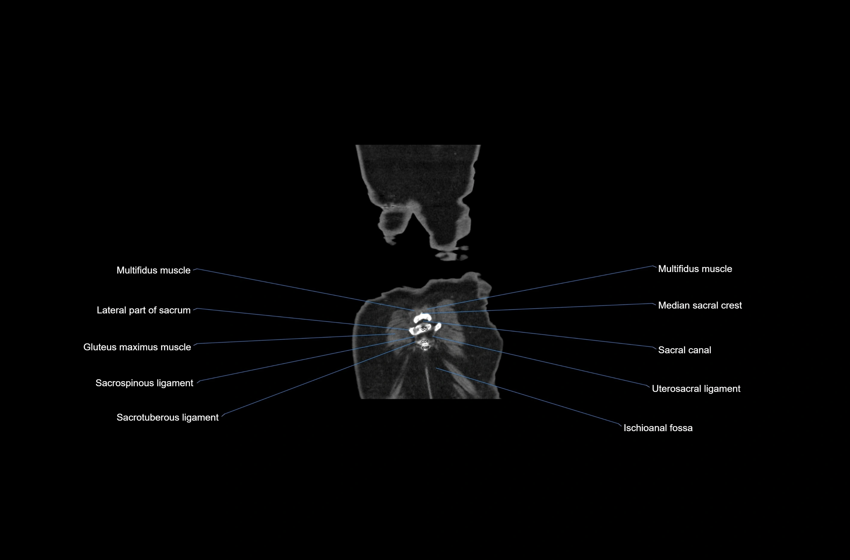 CT abdomen coronal cross sectional anatomy labelled radiology image-00083.webp